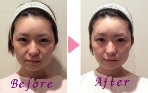 美容鍼 befor & after -2